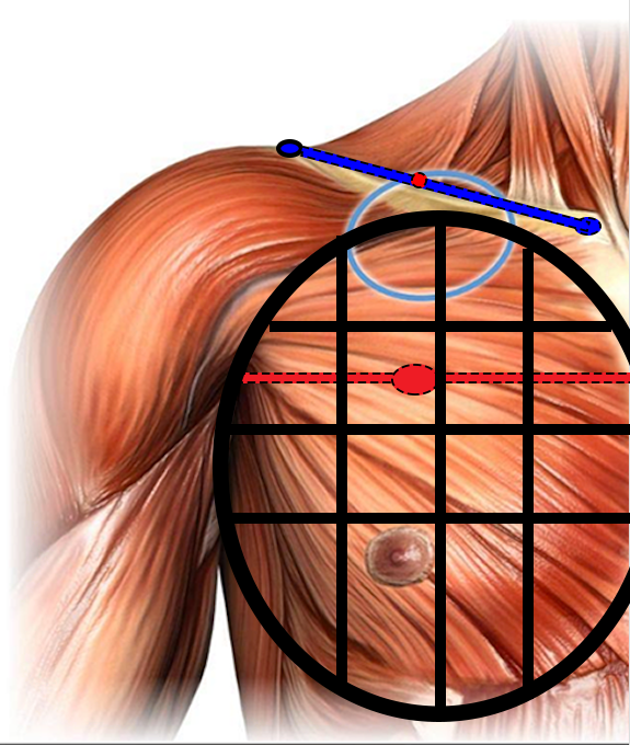 Step3-Pectoroplasty