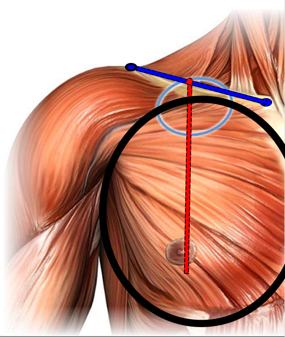 Step4-Pectoroplasty