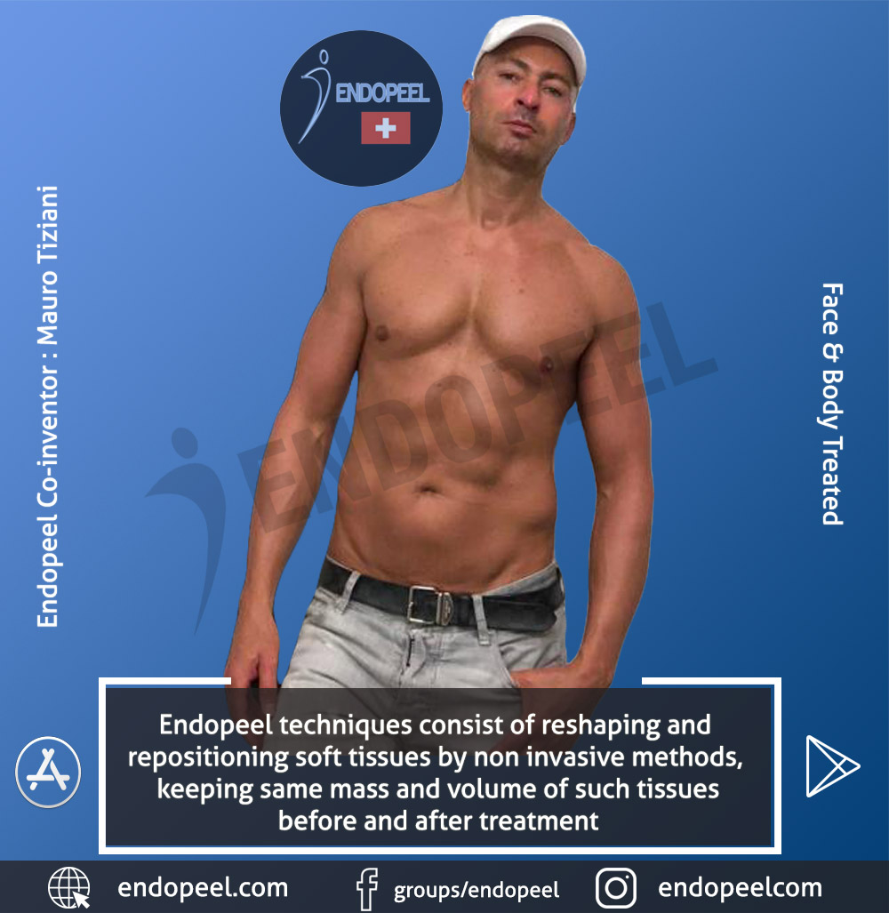 endopeel co inventor
