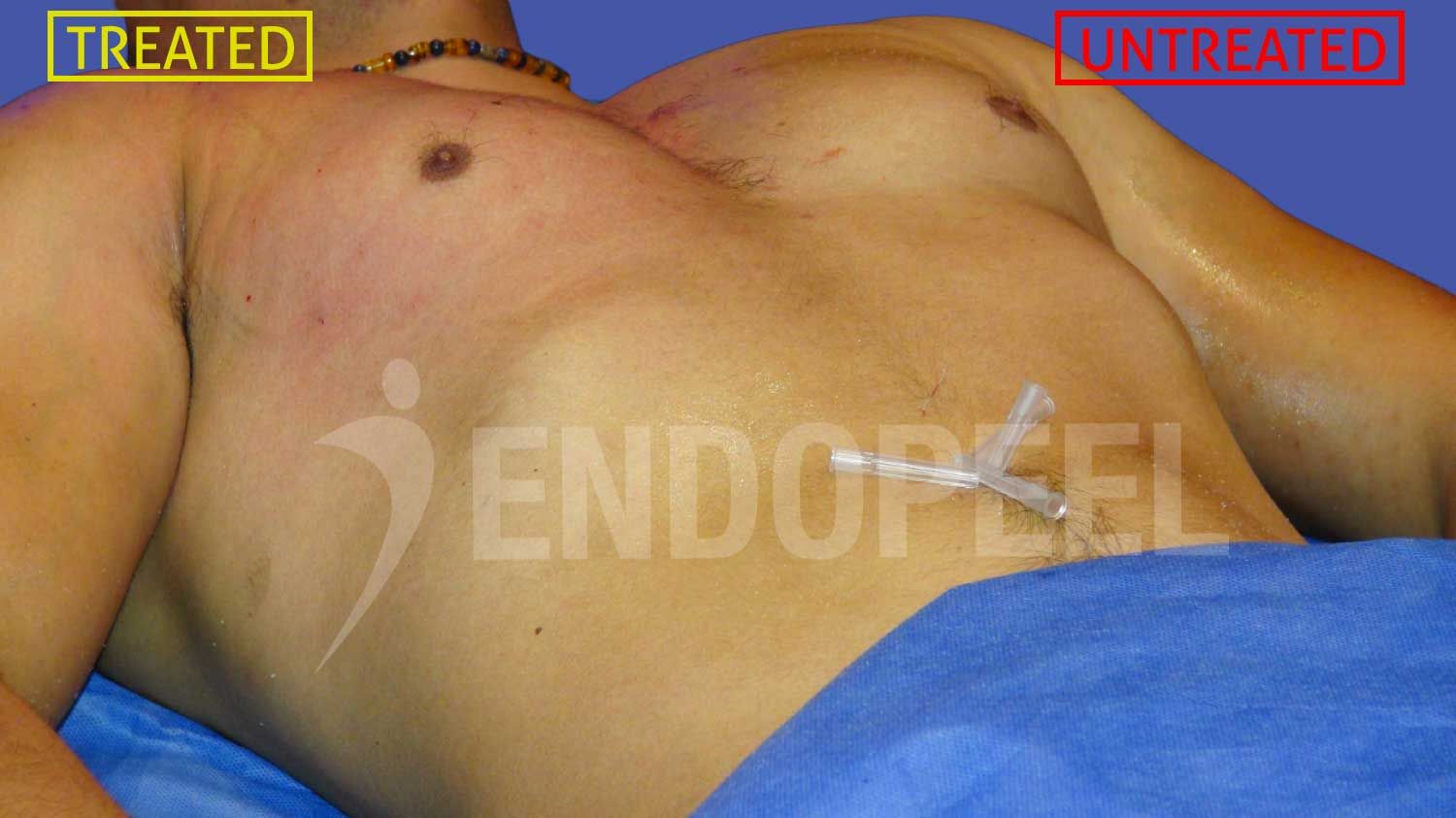 slide5-male-pectoroplasty