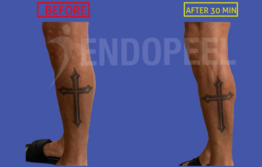 calf plasty male augmentation