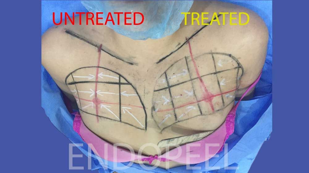 left pectoroplasty on female in dorsal decubitus